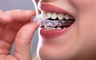 Why You Should Avoid Home Whitening Kits